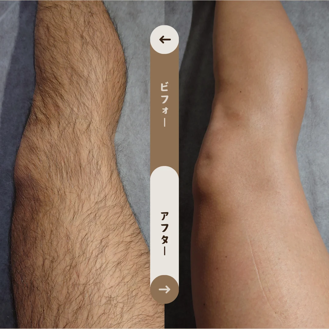 足全体 Before&After