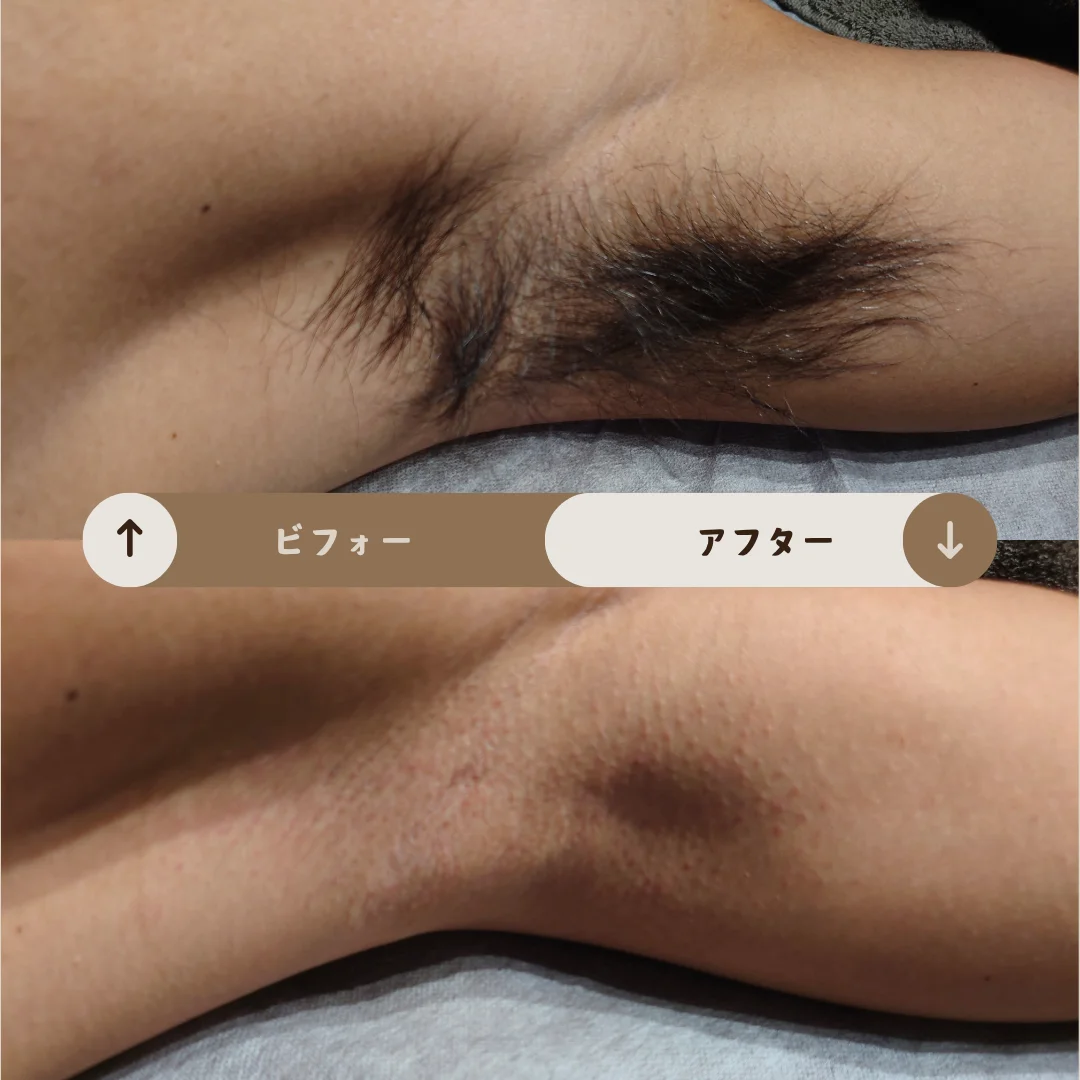脇 Before&After