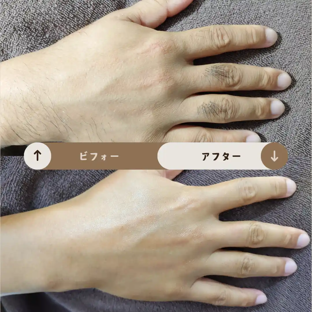 手の指 Before&After