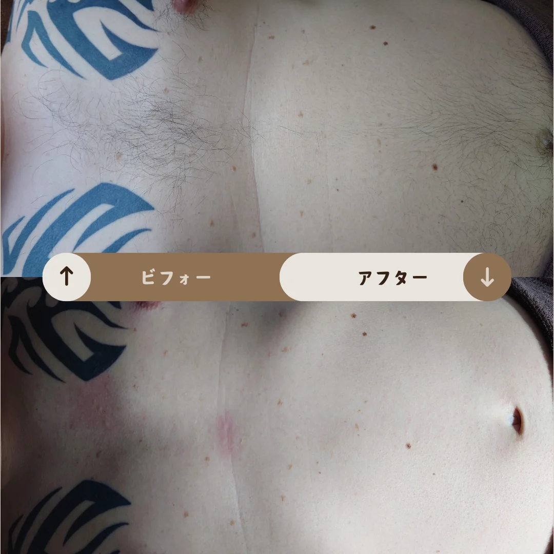 胸と乳首回り Before&After
