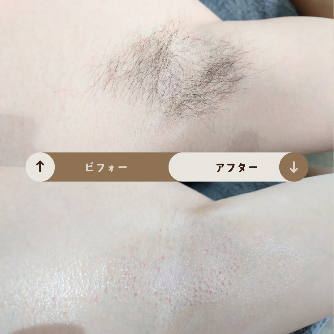 脇 Before&After
