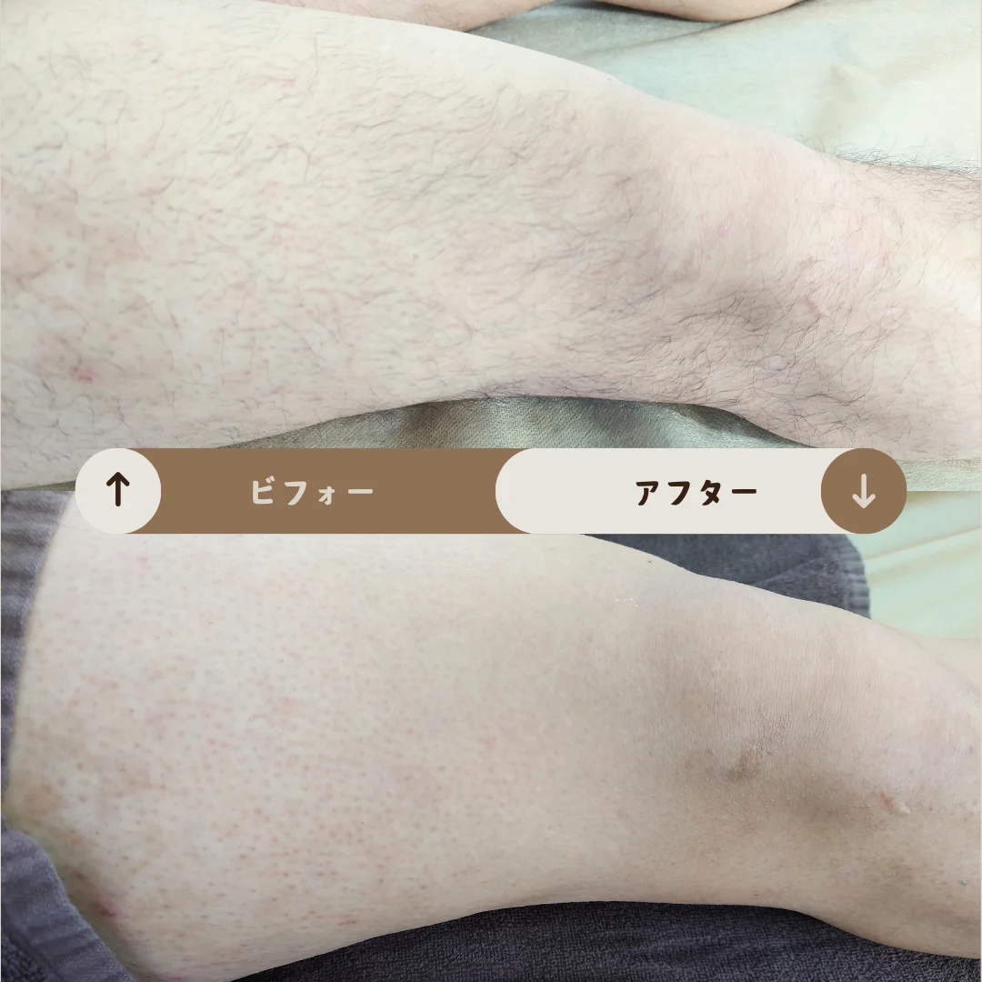 足全体 Before&After