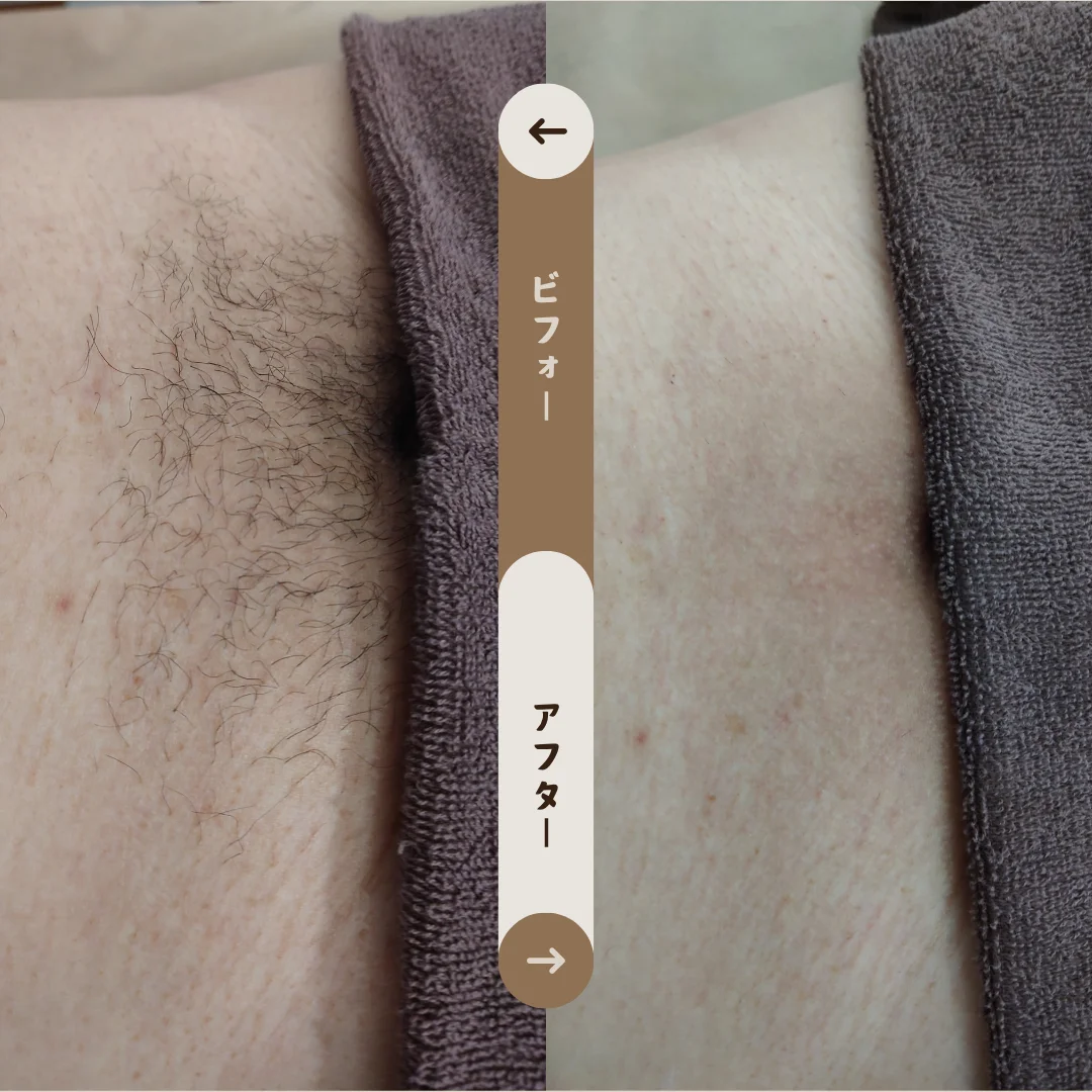 Vライン Before&After