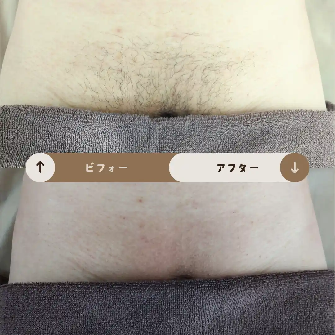 Vライン Before&After