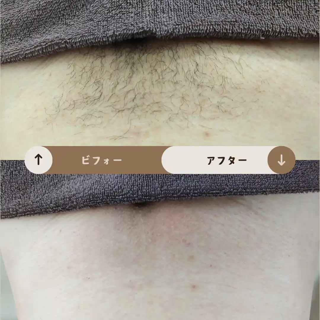 Vライン Before&After