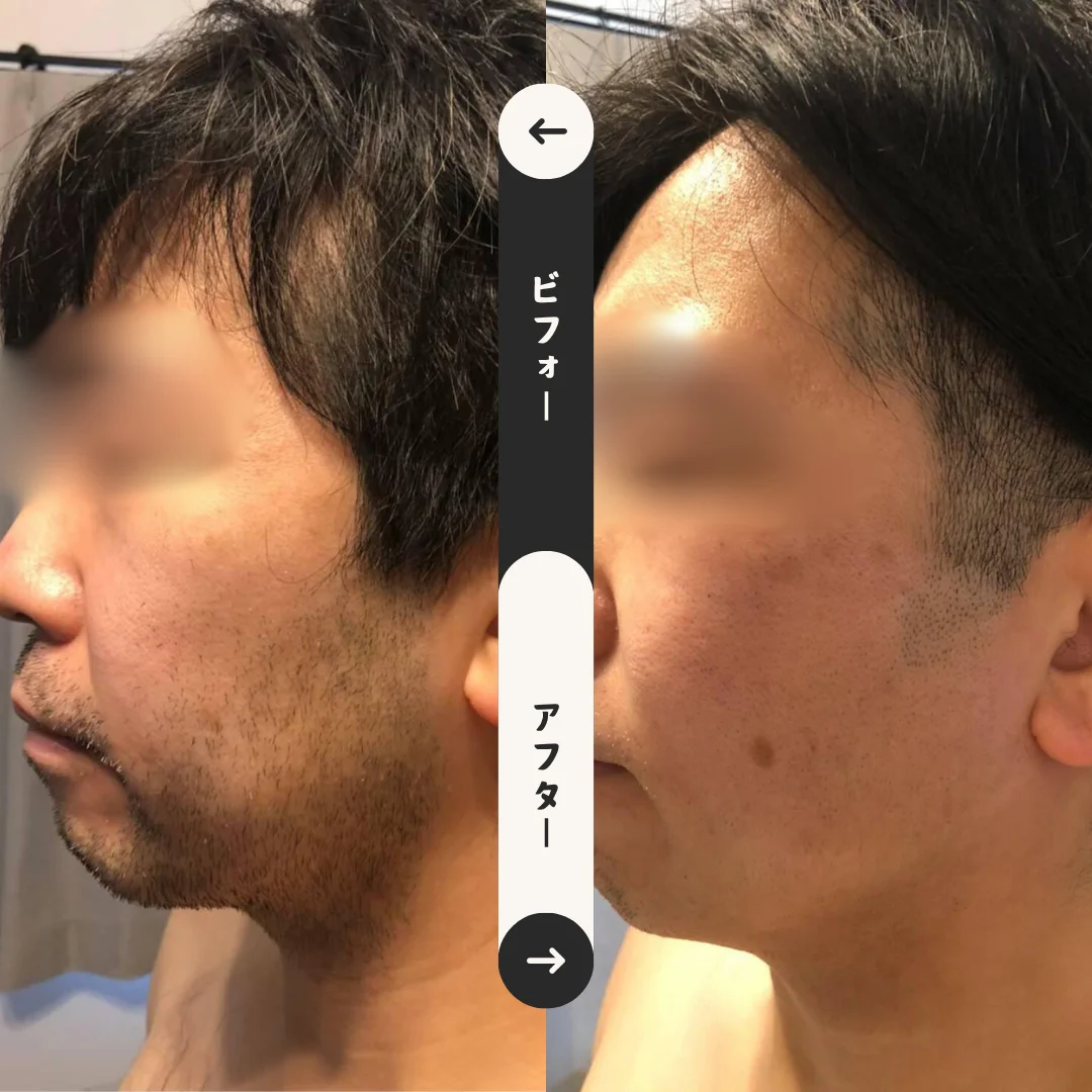 ヒゲまるごと脱毛 Before&After