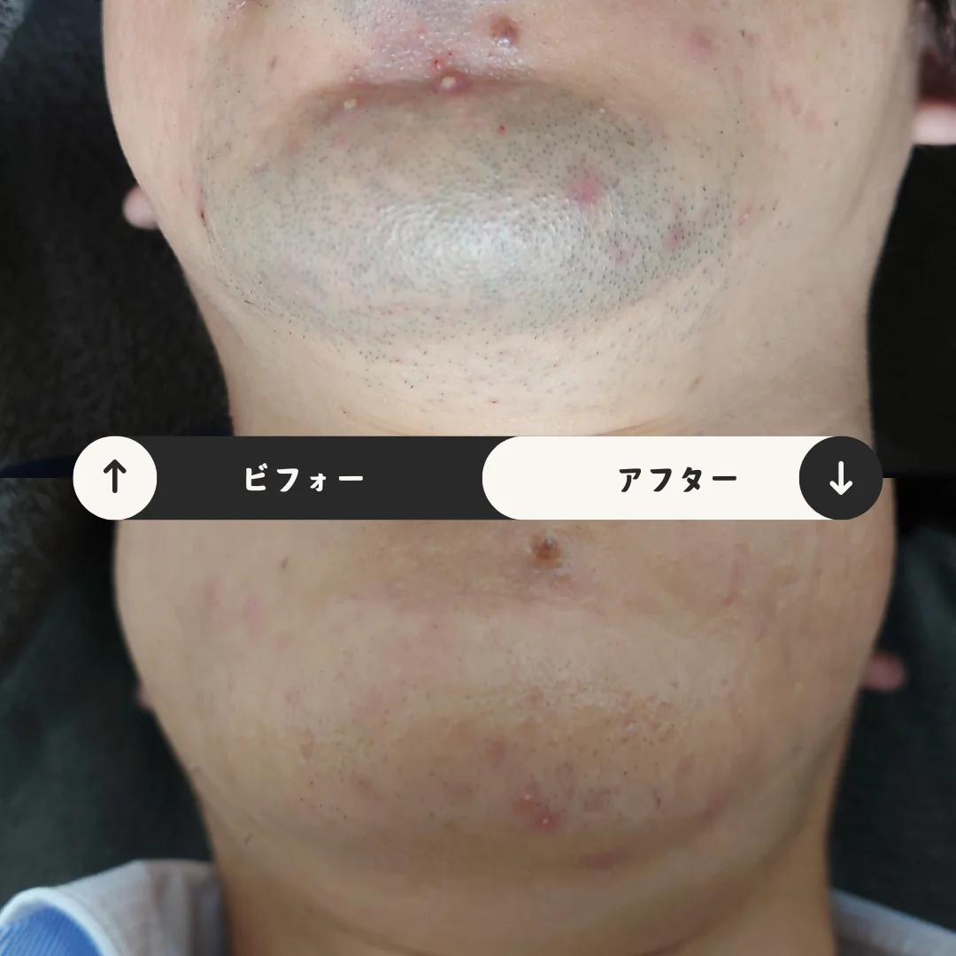 ヒゲまるごと脱毛 Before&After