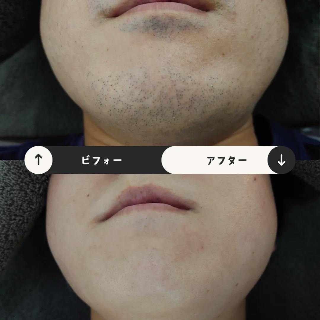 ヒゲまるごと脱毛 Before&After