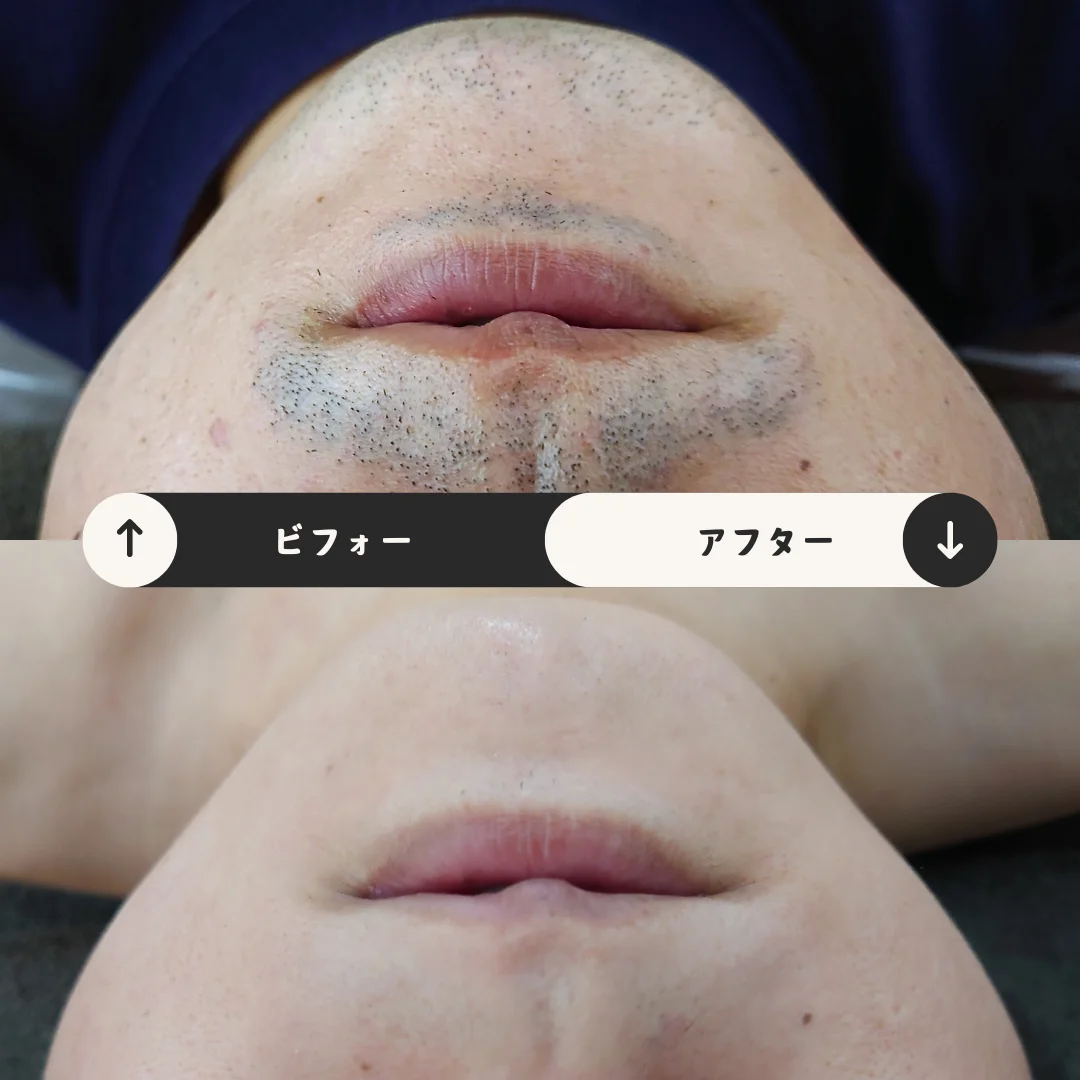 ヒゲまるごと脱毛 Before&After