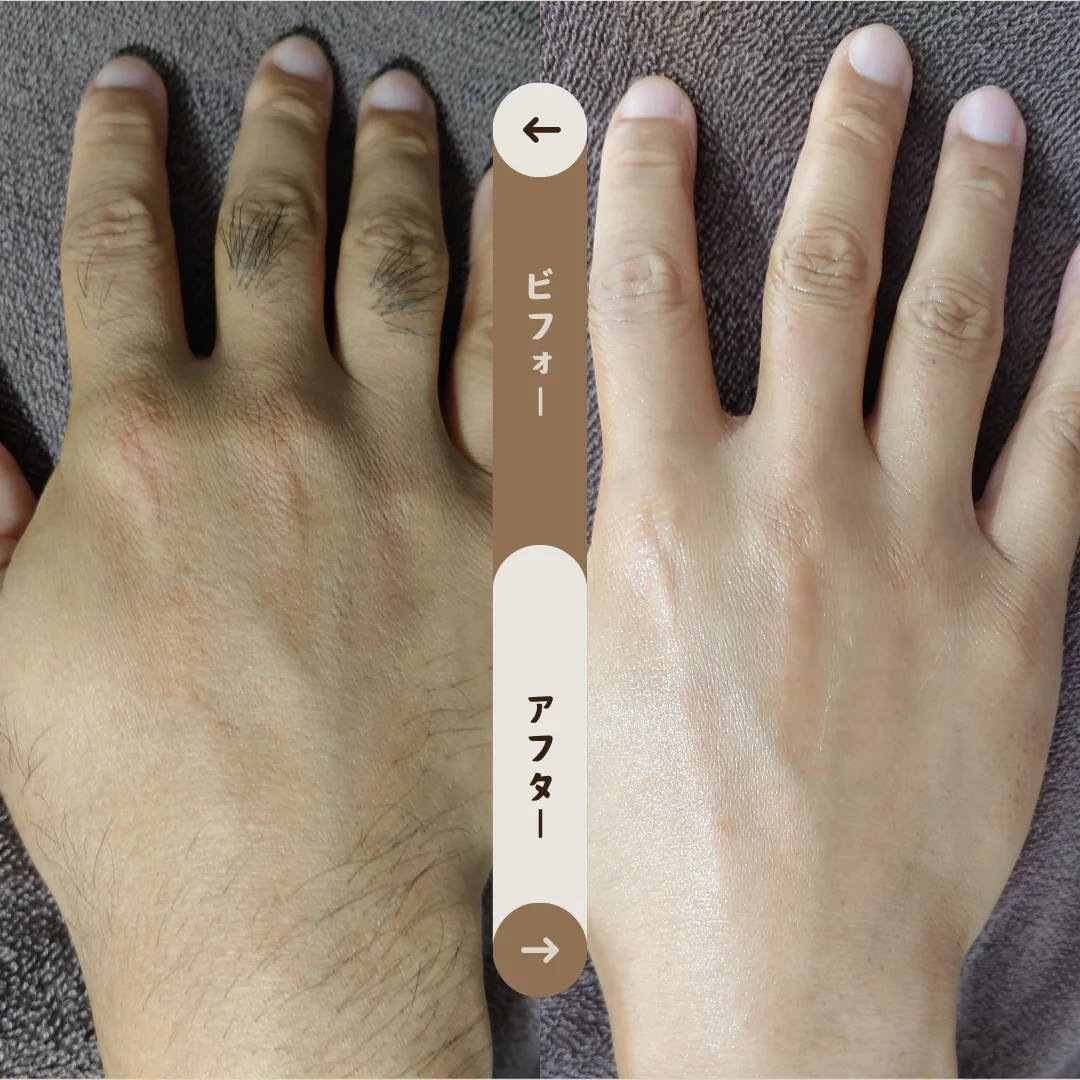 手の甲と指 Before&After