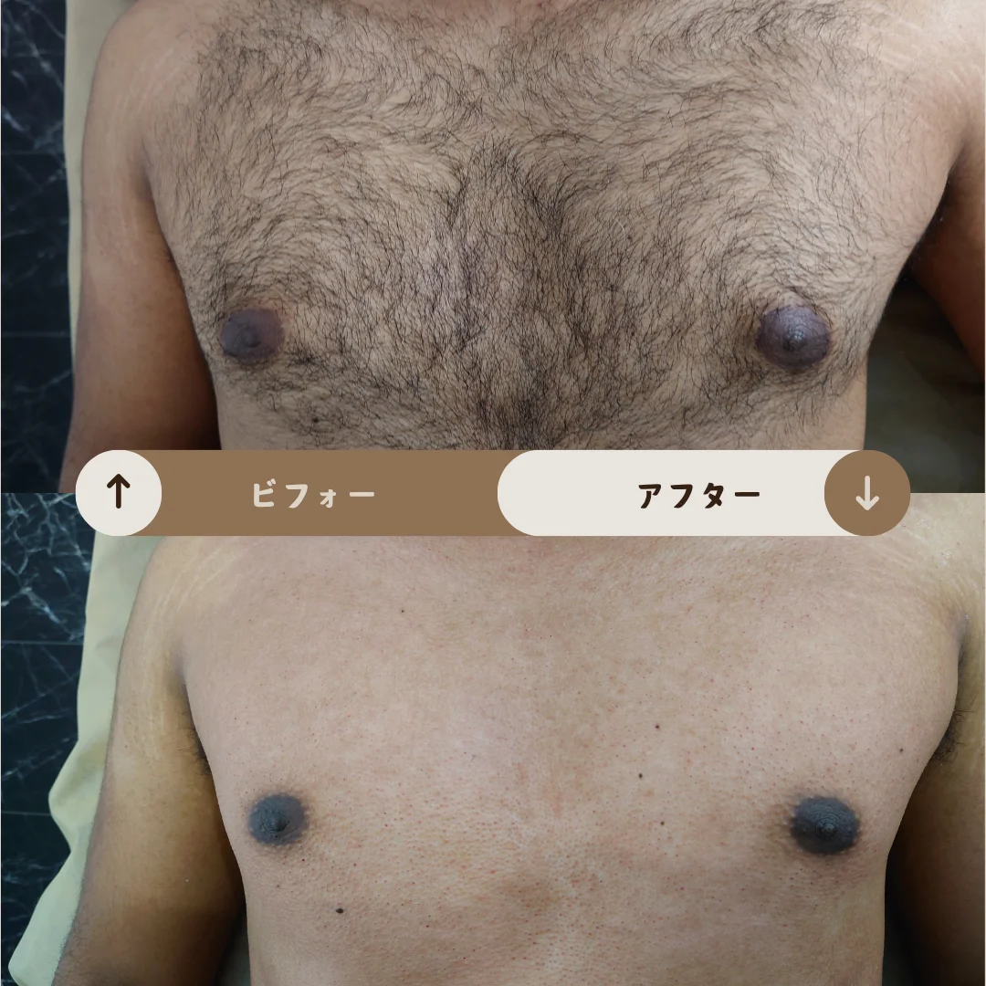 胸と乳首回り Before&After
