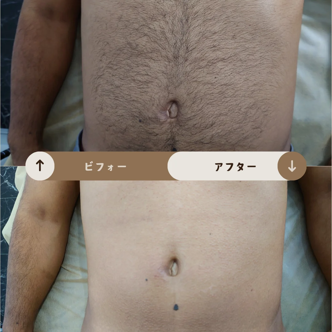 お腹とへそ周り Before&After