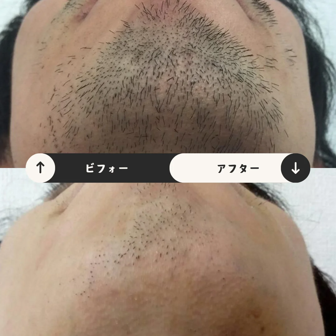 ヒゲまるごと脱毛 Before&After