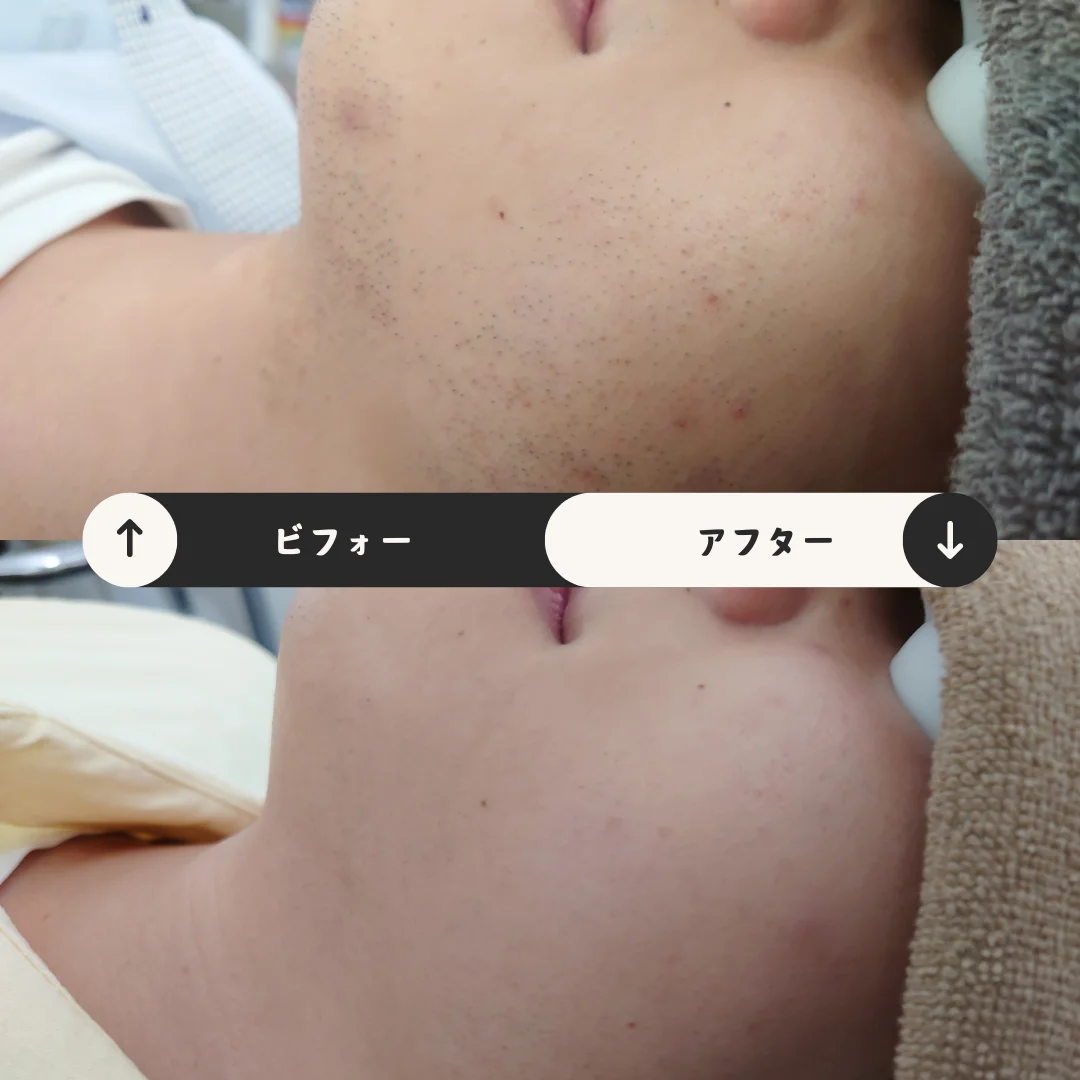 ヒゲまるごと脱毛 Before&After