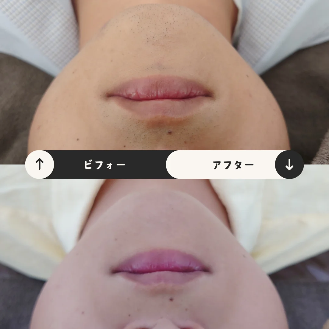 ヒゲまるごと脱毛 Before&After