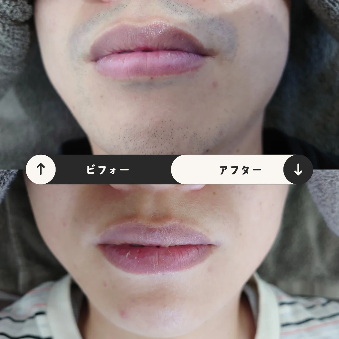 ヒゲまるごと脱毛 Before&After